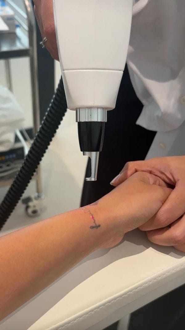 Laser détatouage